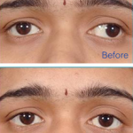 Strabismus